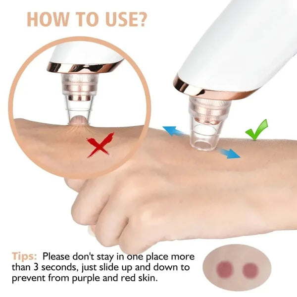 Rechargeable Blackhead Remover Vacuum - Pore Cleaner with 5 Suction Heads